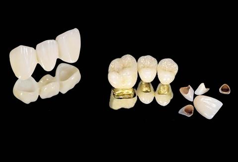 贵金属烤瓷牙的危害(贵金属烤瓷牙和普通烤瓷牙) 贵金属烤瓷牙的危害(贵金属烤瓷牙和普通烤瓷牙)