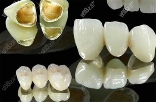 贵金属烤瓷牙的危害(贵金属烤瓷牙冠的优缺点)